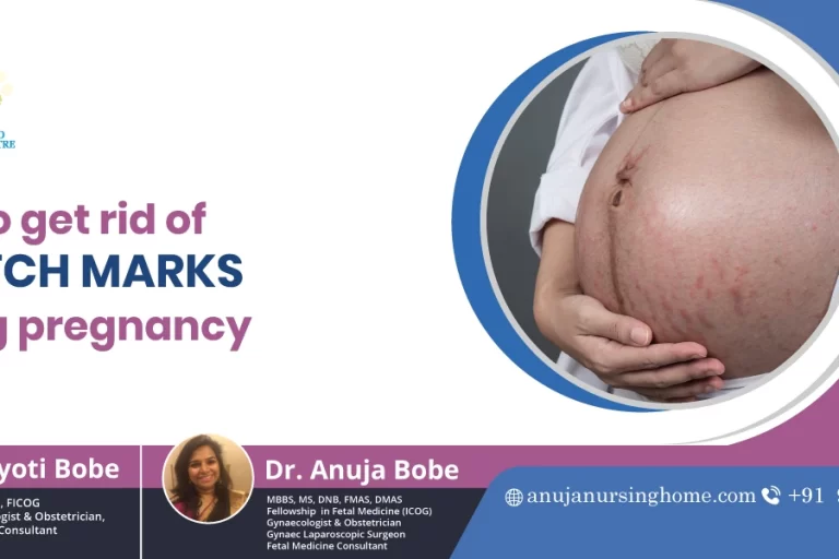 How to get rid of stretch marks during pregnancy