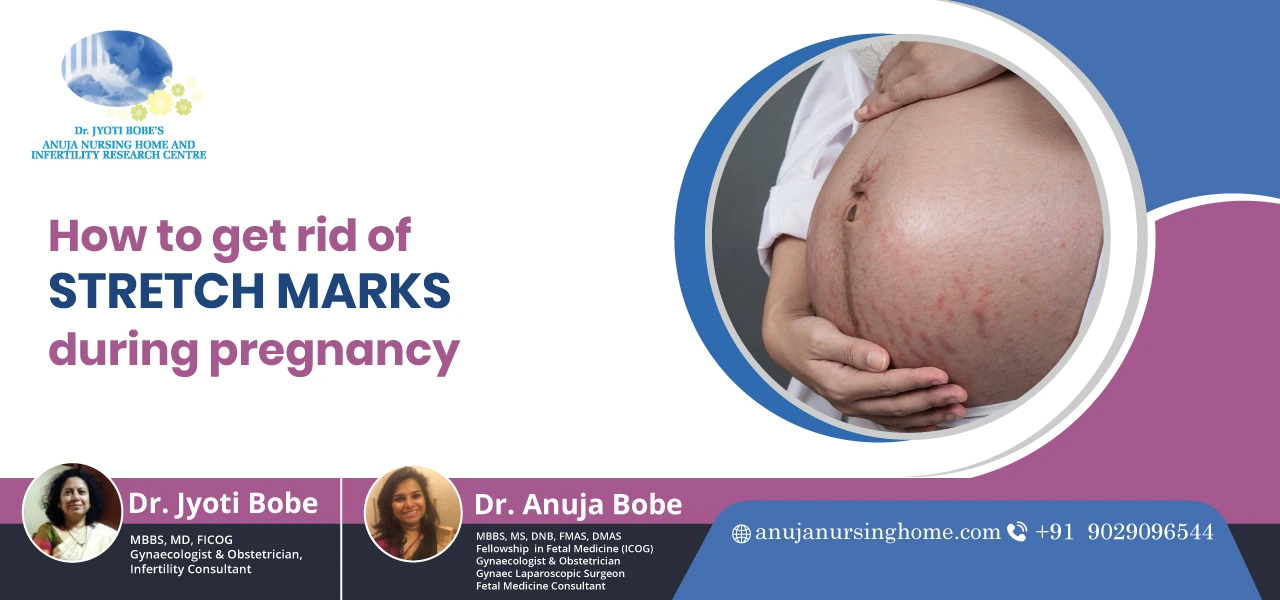 How to get rid of stretch marks during pregnancy